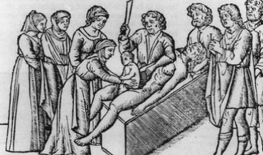 An illustration of an ancient Caesarean section